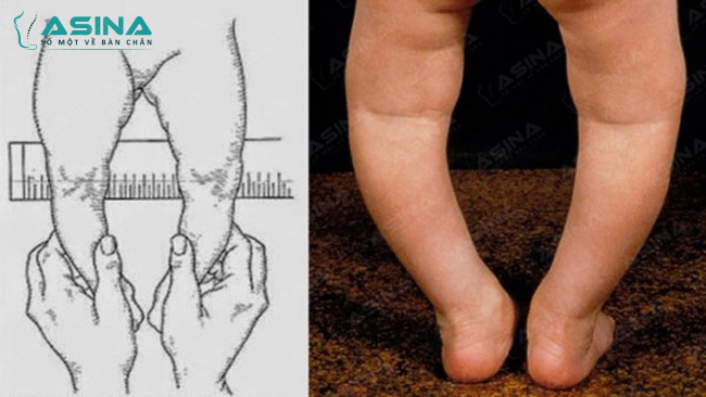 Cách khắc phục chân vòng kiềng hiệu quả từ chuyên gia