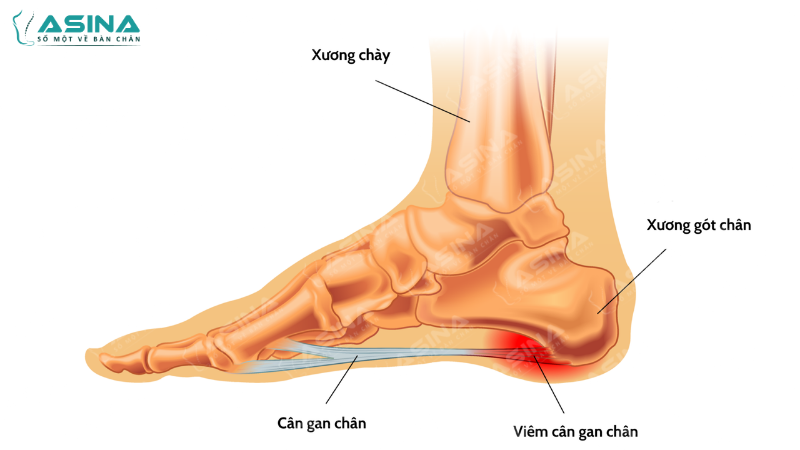 Điều trị viêm cân gan bàn chân đúng cách và ngừa biến chứng