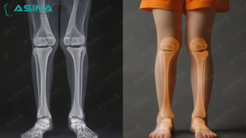 Chân chữ X là gì? Nguyên nhân, dấu hiệu và cách điều trị