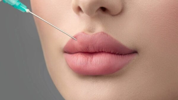 Tiêm filler môi giá bao nhiêu? Tiêm ở đâu đẹp? - Bệnh viện Thẩm mỹ Thu Cúc