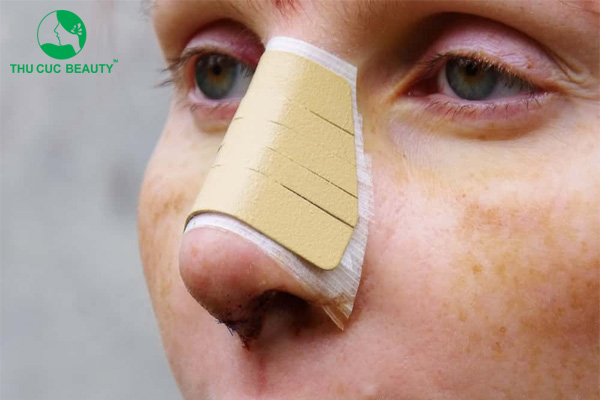 Làm sao để giảm sưng sau nâng mũi? - Bệnh viện Thẩm mỹ Thu Cúc