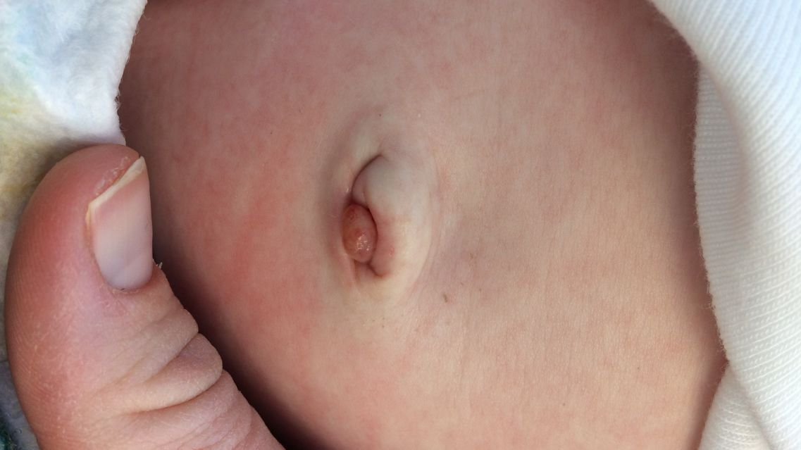 Tồn Tại Ống Niệu Rốn Là Gì? Nguyên Nhân, Triệu Chứng Và Phương Pháp Điều Trị – Chăm sóc trẻ em