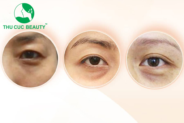 Làm đầy rãnh lệ bao nhiêu tiền? - Bệnh viện Thẩm mỹ Thu Cúc