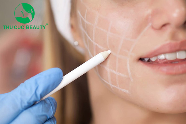 Có nên hút mỡ má không? Ai nên hút mỡ má? - Bệnh viện Thẩm mỹ Thu Cúc