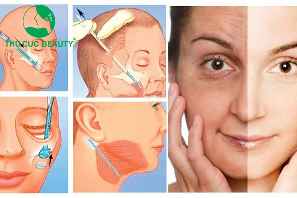 Căng da nội soi là gì? Ưu điểm và khuyết điểm của căng da nội soi - Bệnh viện Thẩm mỹ Thu Cúc