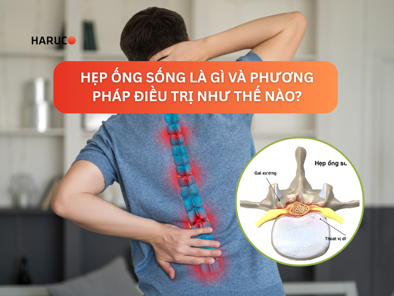 Hẹp ống sống là gì và phương pháp điều trị như thế nào?