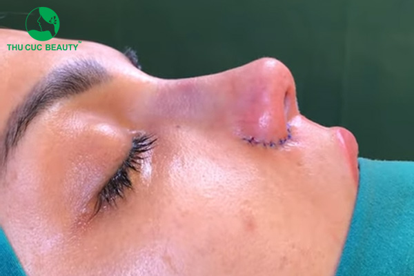 Chi phí thu gọn cánh mũi bao nhiêu tiền? - Bệnh viện Thẩm mỹ Thu Cúc