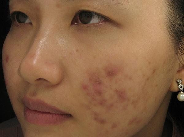 Nghệ tươi trị sẹo mụn: Bí quyết dưỡng da thiên nhiên và cách dùng Curcumin hiệu quả – Chăm sóc da