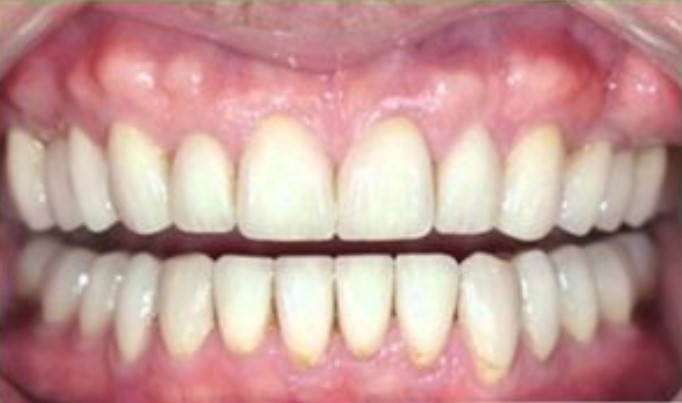 Cost of Full Mouth Dental Implants in Delhi, India