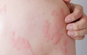 Mề đay: Nguyên nhân, triệu chứng và cách chăm sóc da khi bị mề đay đúng chuẩn da liễu – Chăm sóc da