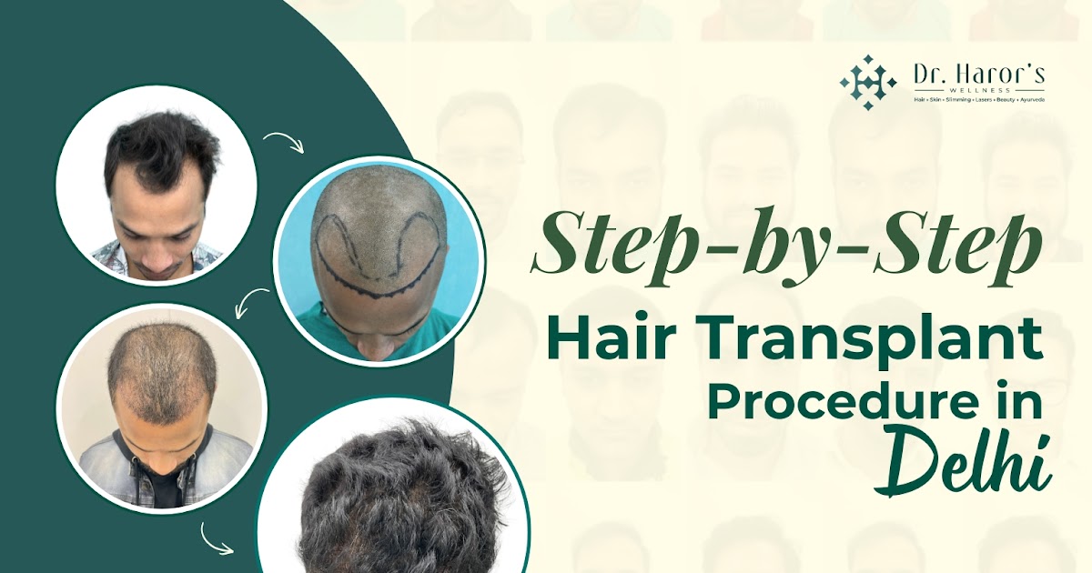 Step-by-Step Hair Transplant Procedure in Delhi