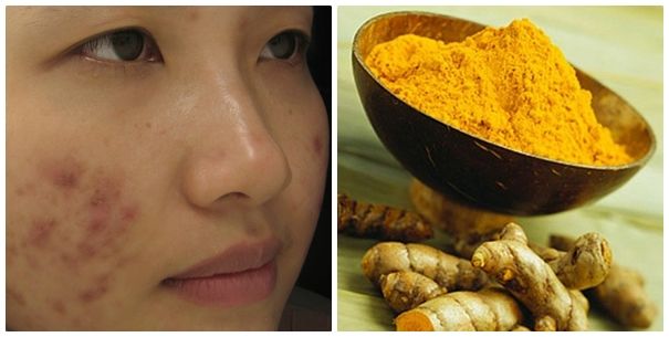 Cách trị thâm mụn hiệu quả và an toàn để lấy lại làn da đều màu – Chăm sóc da