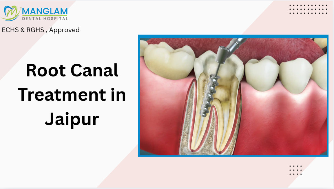 Painless Root Canal Treatment in Jaipur | ECHS & RGHS Available