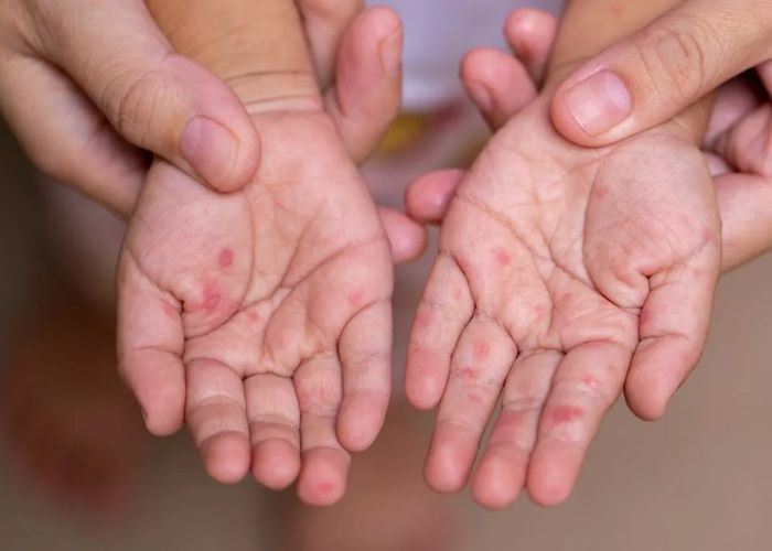 Virus EV71 là gì ? Dấu hiệu nhận biết - biến chứng và cách phòng ngừa