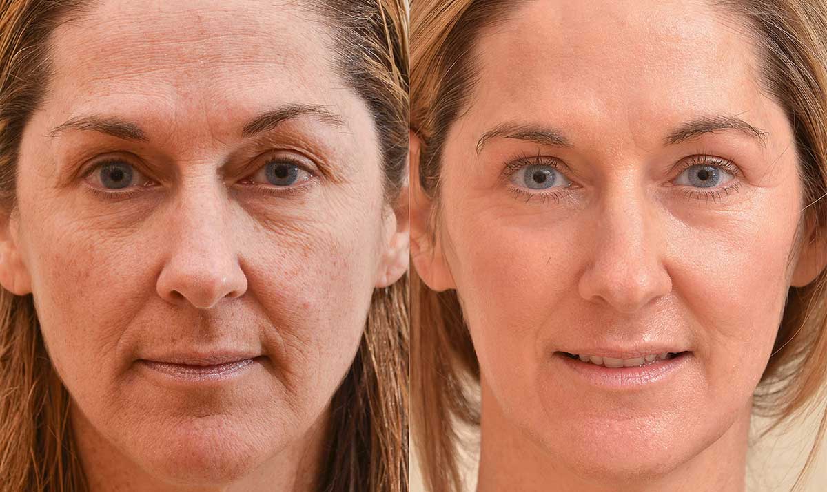 Laser Resurfacing in Cape Town | Laser Facelift (TRL) Treatment