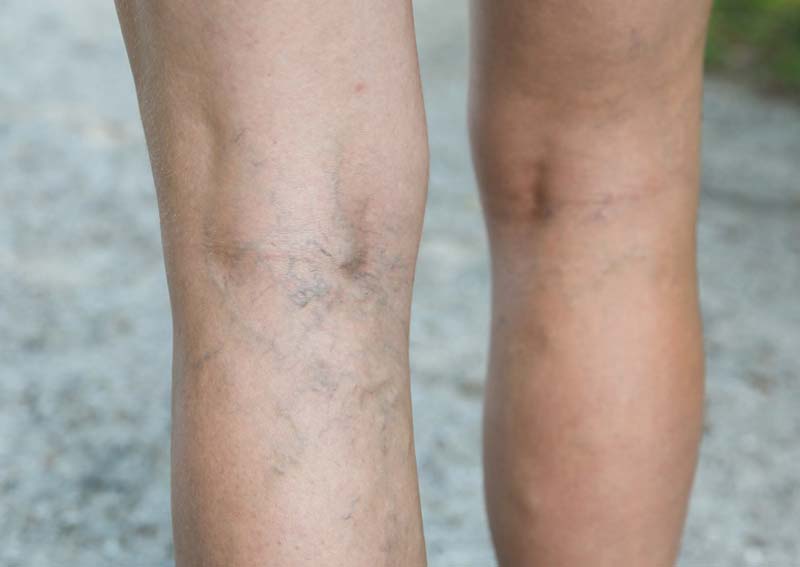 Varicose veins/ spider veins - Atlantic Dermatology & Laser