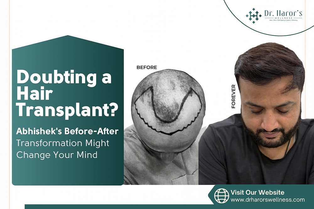 Doubting a Hair Transplant? Abhishek's Before-After Transformation Might Change Your Mind