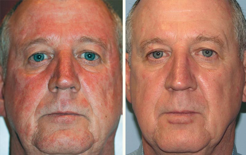 BroadBand Light -BBL™ - Atlantic Dermatology & Laser