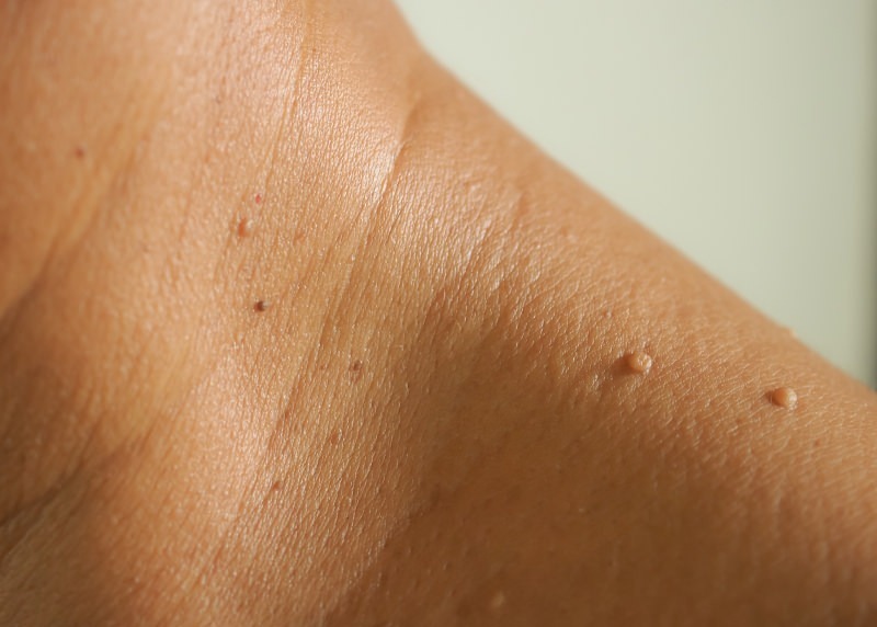 Skin Tags - Atlantic Dermatology & Laser Clinic