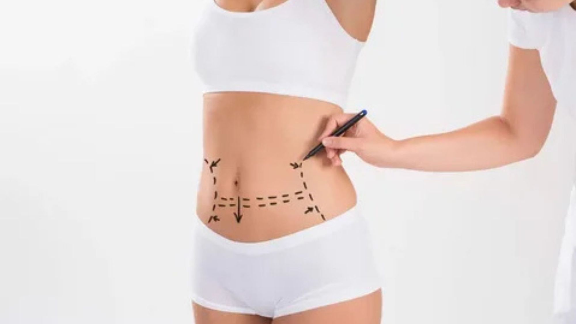 Best Tummy Tuck Surgery in Delhi – Transforming Confidence with Expertise by Dr. Vivek Kumar