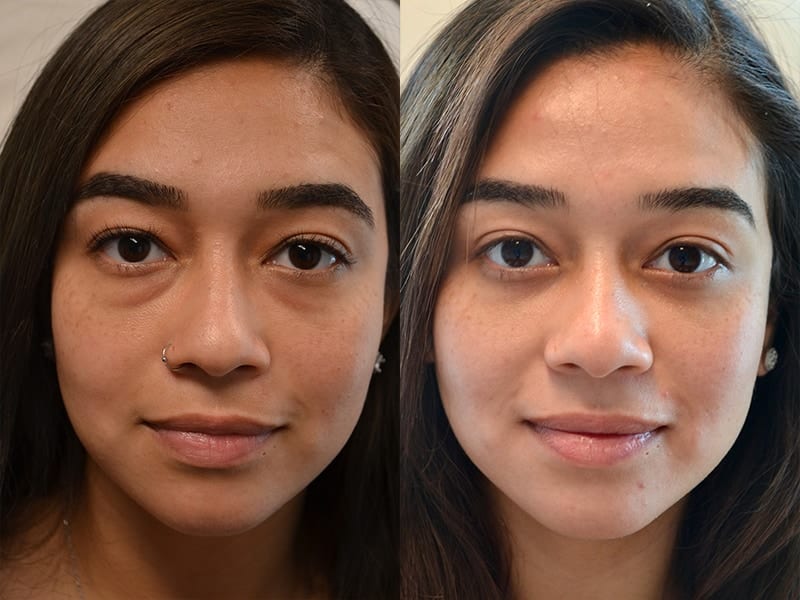 Lower Blepharoplasty Cape Town | Eye Bag Removal Surgery