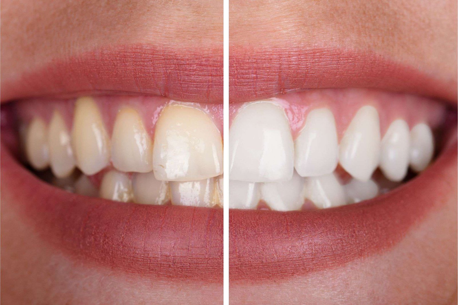 Teeth Whitening Service Puchong | Brighten Your Smile Safely