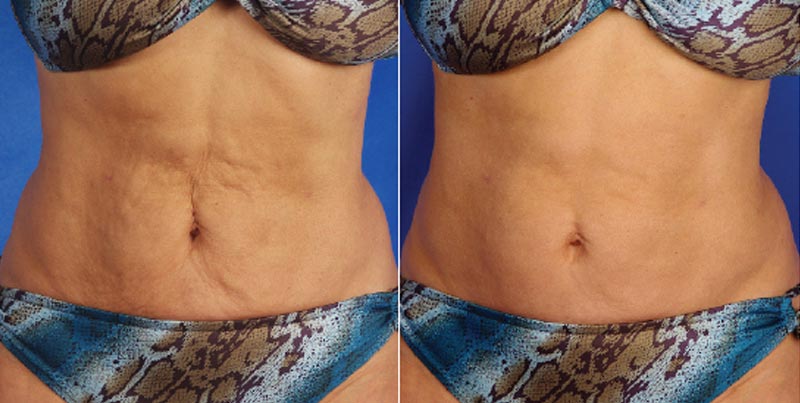 Best Tightening Treatment | SkinTyte Laser Cape Town