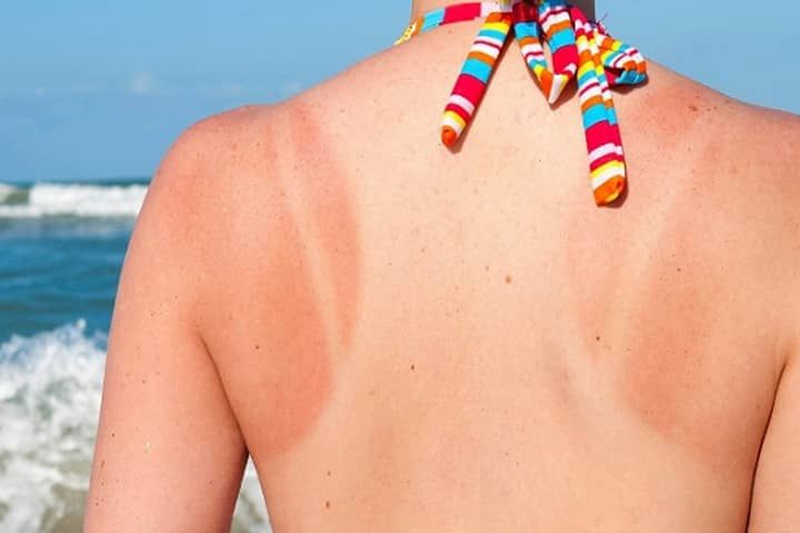 Bí quyết xử lý da cháy nắng và làm dịu da tức thì giúp phục hồi nhanh chóng – Chăm sóc da