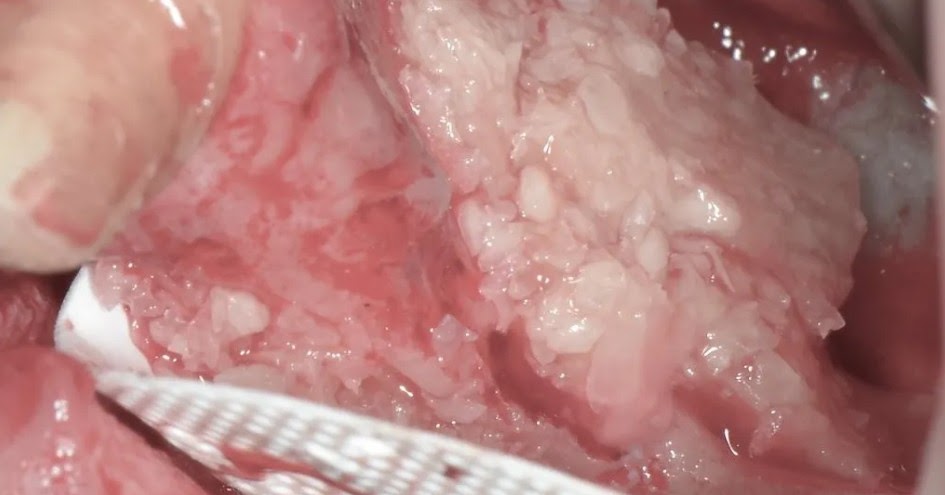 What to Know Before Seeing a Dental Bone Graft Specialist?
