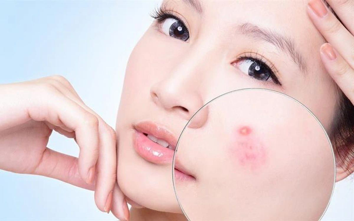Trị mụn nhọt an toàn: Cách xử lý đúng để tránh nhiễm trùng – Newway - Thương hiệu uy tín hàng đầu trong lĩnh vực dược mỹ phẩm
