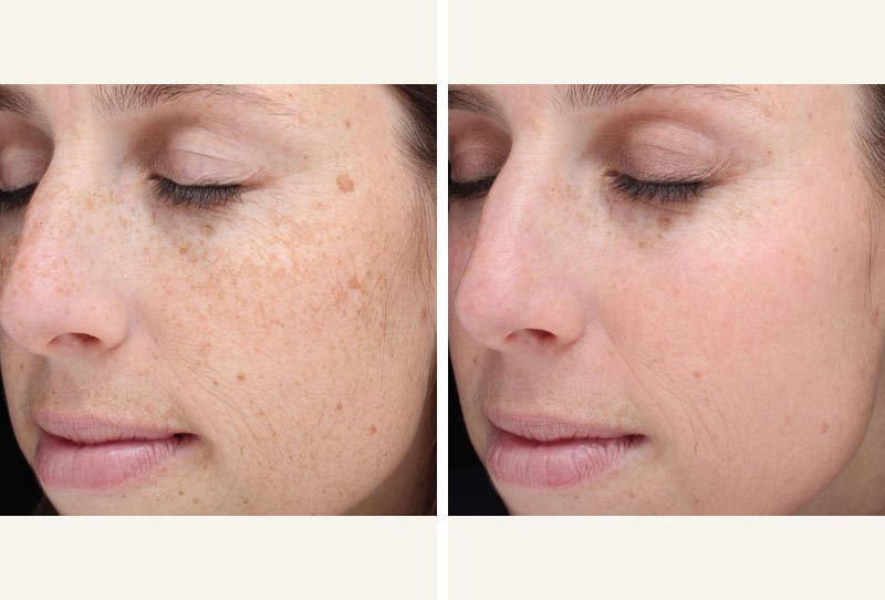 Sunspot Removal | Expert SunDamage Treatment in Cape Town