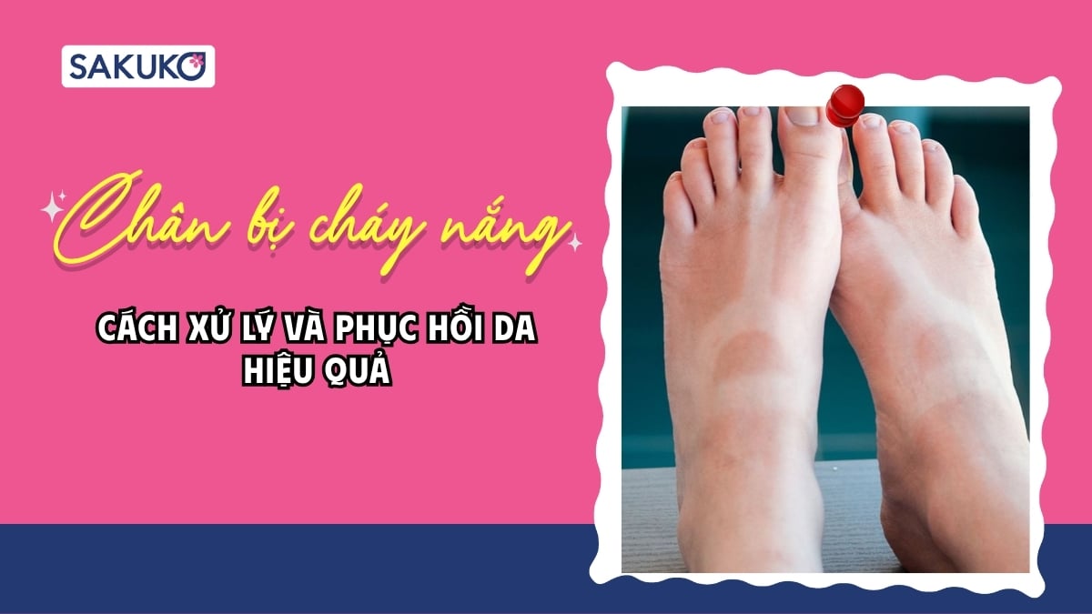 Chân bị cháy nắng phải làm sao? Cách xử lý và phục hồi da hiệu quả